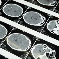 Brain MRI scane
